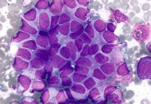 Neuroblastoma en niños: Datos clave para reforzar la concienciación y promover el diagnóstico temprano