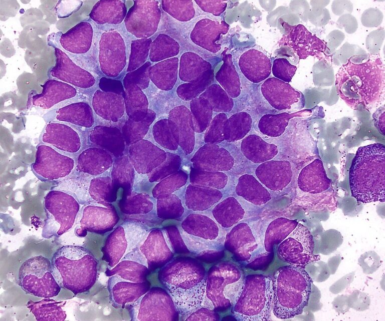 Neuroblastoma en niños: Datos clave para reforzar la concienciación y promover el diagnóstico temprano