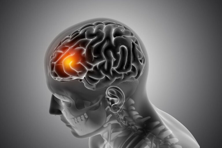 Nueva indicación permite detener un infarto cerebral en segundos