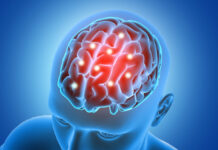 El 44% de los pacientes de Infarto Cerebral podrían padecer secuelas