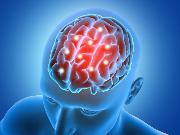 El 44% de los pacientes de Infarto Cerebral podrían padecer secuelas