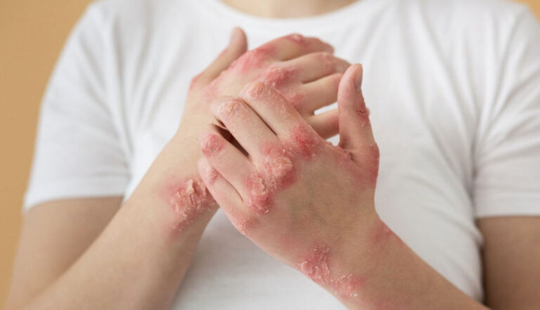 Más allá de la piel: la depresión puede afectar hasta a 6 de cada 10 personas con psoriasis